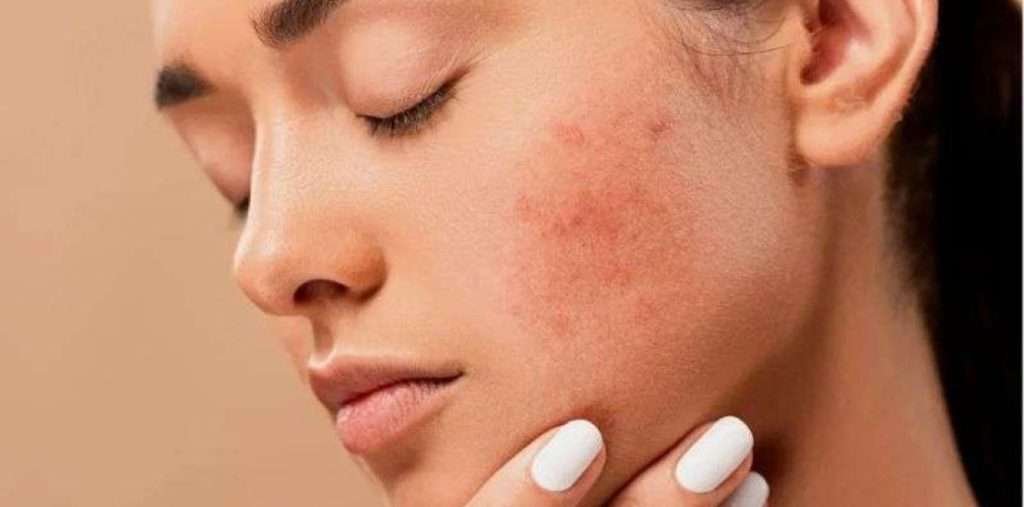 Guía Definitiva para Prevenir el Acné