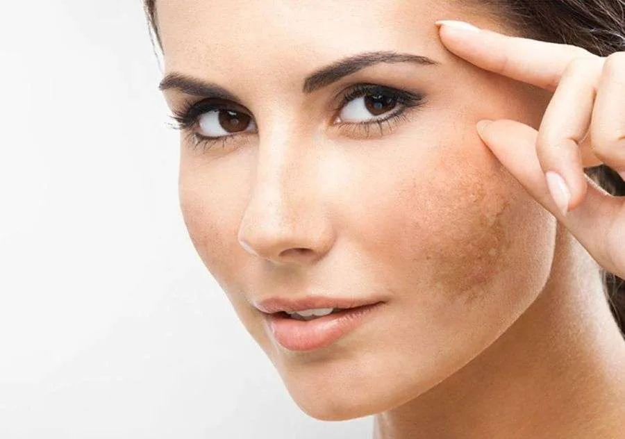 tratamiento para las manchas de la cara