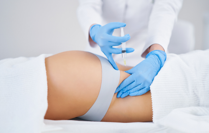Bioestimulador de colágeno en glúteos